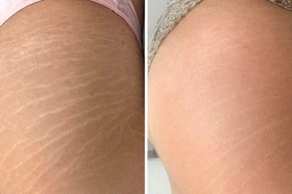 Tratamento para Estrias Método Microderme