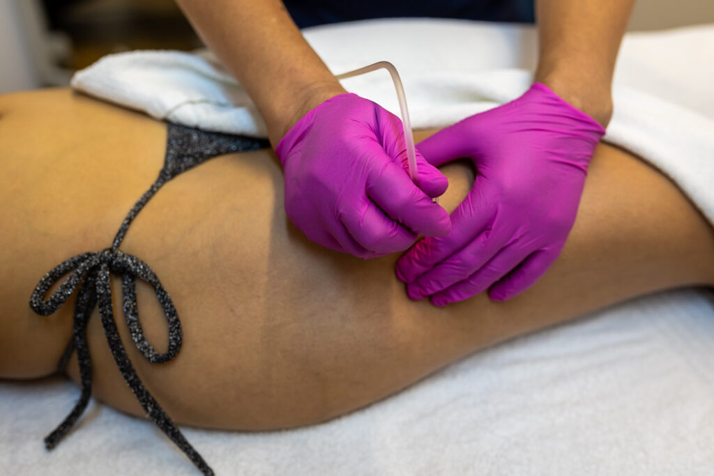 Impacto Estética Avançada tratamento para estrias